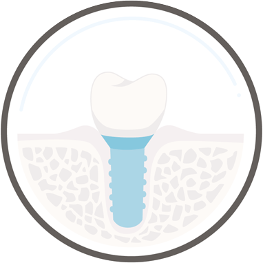 Implantologie Köln - Zahnkultur ist Ihr Zahnarzt Köln für moderne Zahnimplantate