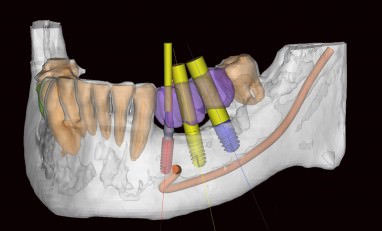 Diagnostik bei Zahnimplantat und Oralchirurgie: Navigationsplanung mittels digitaler Volumentomographie